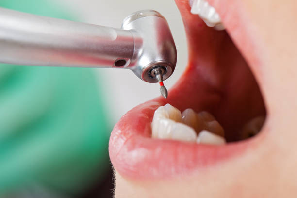 Best Emergency Wisdom Teeth Removal in Big Rock, IL